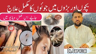 Sar Ki Juen Khatam Karne Ka Tarika  Head Lice Removal  Lice In Hair Symptoms Causes And Treatment [upl. by Lyckman]