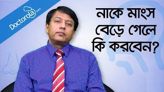 Hypertrophy nasal turbinates  নাকের মাংস বৃদ্ধি  নাকের মাংস বাড়লে করণীয়  Blocked nose relief [upl. by Rosabelle808]