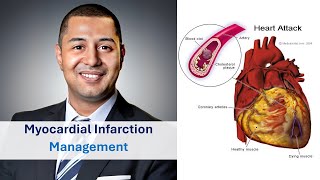 Acute Myocardial Infarction Management [upl. by Oecam889]