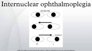 Internuclear ophthalmoplegia [upl. by Ednalrim]