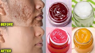 5 homemade face creams to remove dark spots pigmentation acne scars fast  Get clear glowing skin [upl. by Jentoft]