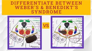 Midbrain Syndromes  Benedikts VS Webers syndrome [upl. by Nitsoj]