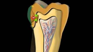 Dental Caries Treatment [upl. by Persas441]