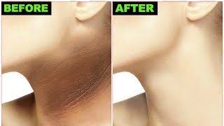 Dark Neck Home Remedy  Quick Lightening amp Whitening DIY ridofdarkneck [upl. by Brandi289]