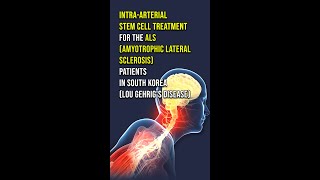 Intraarterial Stem Cell Treatment for the Lou Gehrigs disease Patients in South Korea [upl. by Cutcliffe329]