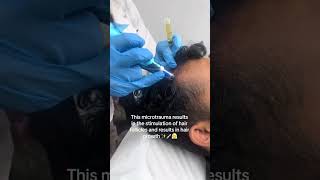 PRP Treatment for hair loss prptreatment londonontario [upl. by Trimble]