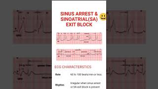 Sinus Arrest and Sinoatrial Exit Block شرح باللغة العربية [upl. by Shuler]