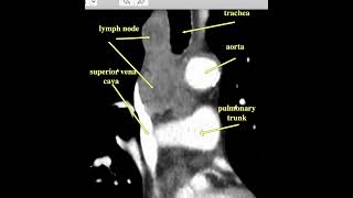 mediastinaladenopathy [upl. by Kal]