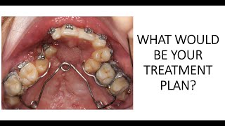 Cleft Lip and Palate  Tertiary Alveolar bone graft and Orthodontic Treatment [upl. by Foulk]