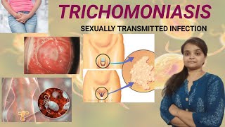 TRICHOMONIASIS cause treatmentprevention [upl. by Enutrof]