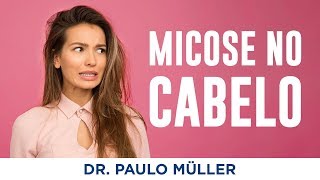 Micose nos Cabelos Micose no Couro Cabeludo  Dr Paulo Müller Dermatologista [upl. by Sharos]