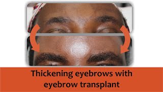 Eyebrow transplant [upl. by Stevie]