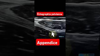 Échographie pelvienne Appendice normal docteur Appendice algeria [upl. by Atsillac]