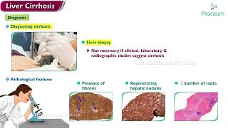 Liver cirrhosis  Etiology  Pathology  Clinical manifestations  Diagnosis  Treatment [upl. by Xymenes778]