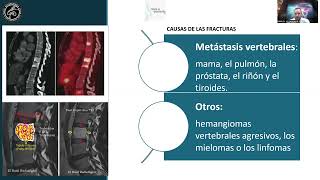 SPINE WEBINAR 56 VERTEBROCIFOPLASTIA EN FRACTURAS VERTEBRALES Y DISCUSION DE CASOS CLINICOS [upl. by Oler]