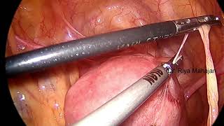 STEP 1  BOWEL AND OMENTAL ADHESIOLYSIS [upl. by Eenimod281]