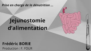 Pose de jéjunostomie dalimentation [upl. by Arramahs81]