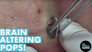 The POPS That Altered My Brain Chemistry 20 Minutes Dr Pimple Popper Best Of [upl. by Nagyam656]