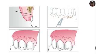 Gingivectomy and Gingivoplasty [upl. by Otrebron969]