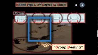 ECG Video8 Blog 105  AV Block 12512015 [upl. by Gail]