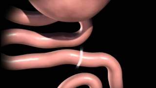 Roux en Y gastric bypass animation [upl. by Adalbert]