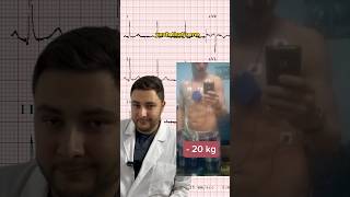 Holter ECG  Explained 🤓 medicalstudent medicaleducation futuredoctor medical cardiology ecg [upl. by Anivlac]