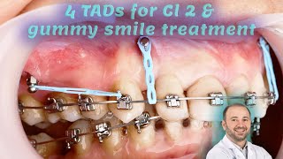 gummy smile amp Cl 2 treatment using IZC amp frontal TADs Mini screw insertion power chain installation [upl. by Zitvaa]