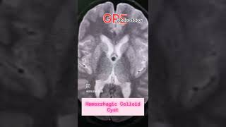 Hemorrhagic colloidCyst foramen of Monroe neuroradiology mri ventricle s9teleradiology cns [upl. by Etiuqal]