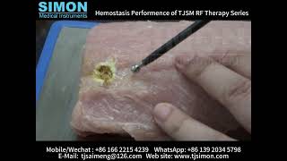 Simon RF ablation preformences [upl. by Lorsung]