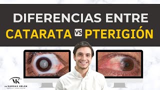 👁 Descubre las DIFERENCIAS entre CATARATA Y PTERIGIÓN Muchos piensan que son lo mismo 🤦🏻‍♂️ [upl. by Ellenhoj]