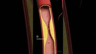 Atherosclerosis viralreels anatomy biology physiotharapist exercise doctorscience [upl. by Alathia]