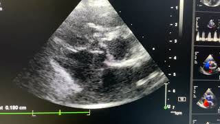 Isolated Gerbode defect [upl. by Aaronson]