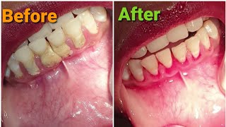 teeth clening periodontitis dental OralDentalCare DDC [upl. by Seaden244]