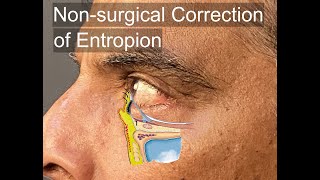 NonSurgical Correction of Involutional Entropion [upl. by Mcquoid263]