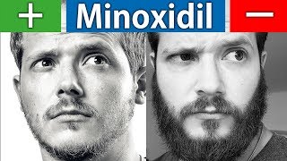 Die Vor und Nachteile von Minoxidil  Kurz und Knapp [upl. by Lilias]