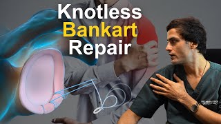 कंधा बारबार उतर रहा है Recurrent Shoulder Dislocation Treatment Knotless Bankart Repair [upl. by Brote221]