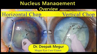 Phaco BasicsNucleus management pearls amp pitfalls  Dr Deepak Megur [upl. by Zetneuq124]