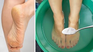 Get Rid of CRACKED HEELS Permanently  Magical Home Remedy [upl. by Abate770]