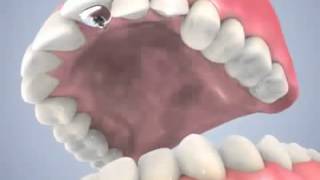 Orthodontie linguale 3D [upl. by Ayenet]