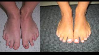 Limb Lengthening and Toe Lengthening with Dr Rozbruch Susans Story [upl. by Emyle]