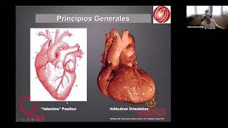 EXTRASÍSTOLES VENTRICULARES LOCALIZACIÓN MEDIANTE ECG DE SUPERFICIE PREPARANDO LA ABLACIÓN [upl. by Schlosser959]