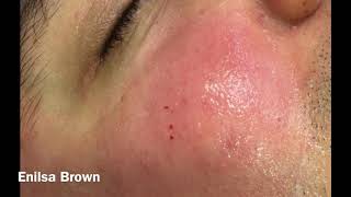 Christians Acne Treatment  Blackheads Extractions [upl. by Pessa688]