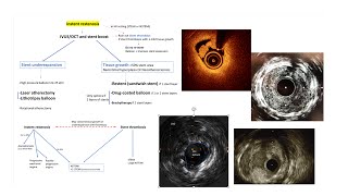 DES instent restenosis mechanisms and interventional management Elias Hanna [upl. by Petigny]