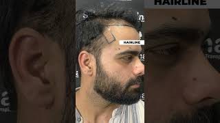 Hair Transplant Success Story at Skinaa Clinic  Patient Feedback viral shorts [upl. by Acinorrev]