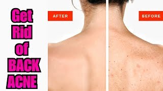 Remove BACK PIMPLES LEG ACNE ARMS ACNE  Removal of Body Acne [upl. by Hijoung116]