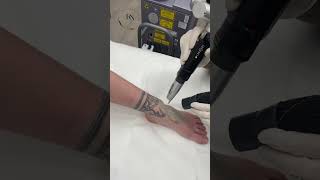 ازاله التاتو بستخدام الليزر بدون ألم ازالهوشم ازالهتاتوبليزر kirolostatoo اكسبلور tattoo [upl. by Atikim]