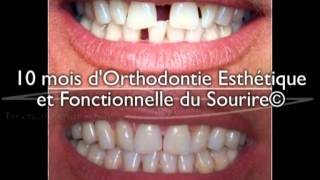 Dents écartées  diastème sur un adulte  correction avec 10 mois daligneurs® en OEFS© [upl. by Weissman707]