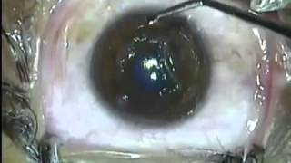 LASIK laser eye Surgery video EPI LASIK [upl. by Snodgrass]