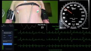 Fast Tachycardia beats while Standing w Breathholding ECG 2x Blood Pressure Cuff [upl. by Aerdnat276]