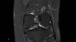 Patient with nontraumatic knee pain and locking cartilage defect in the medial femoral condyle [upl. by Atiuqiram452]